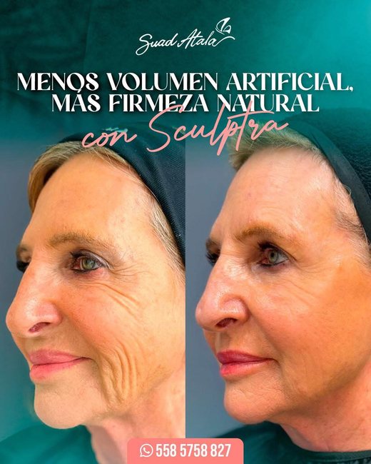 Antes y después de firmeza natural